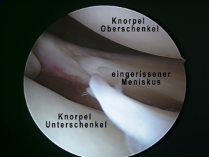 Eingerissener Miniskus