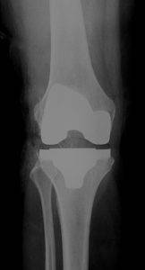 Knietotalendoprothese (KTEP) von vorne, Operateur Dr. Thomas Wieland