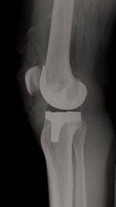 Knietotalendoprothese (KTEP) seitlich, Operateur Dr. Thomas Wieland