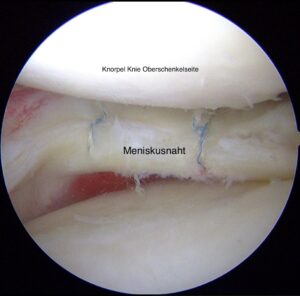 Meniskusriss mit Naht Dr. Thomas Wieland